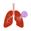 Tuberculosis